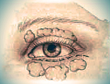 Blepharoplasty