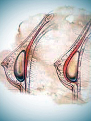 Breast augmentatio